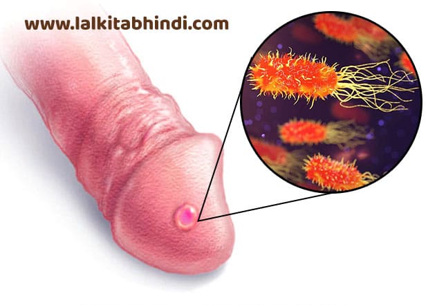 पुराने सुजाक रोग की आयुर्वेदिक दवा